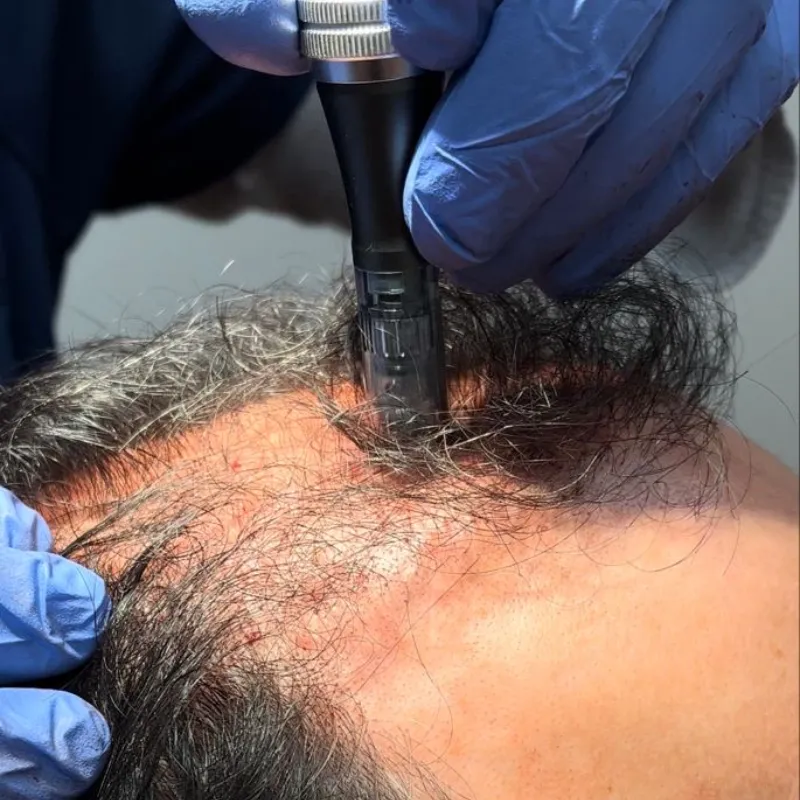 Microneedling Capilar con Dermapen