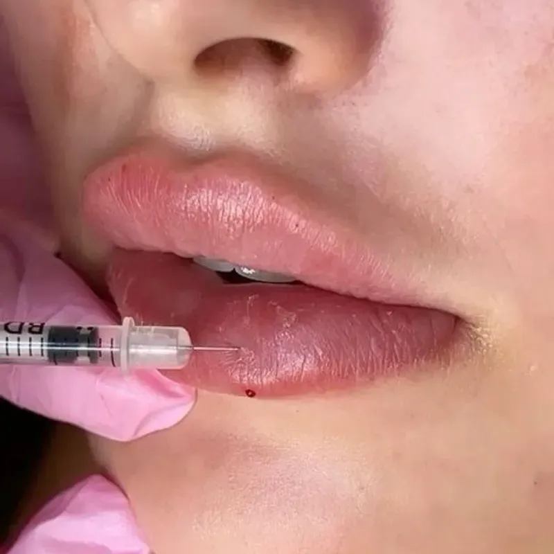 💋 Aumento de Labios (Filler Lips)