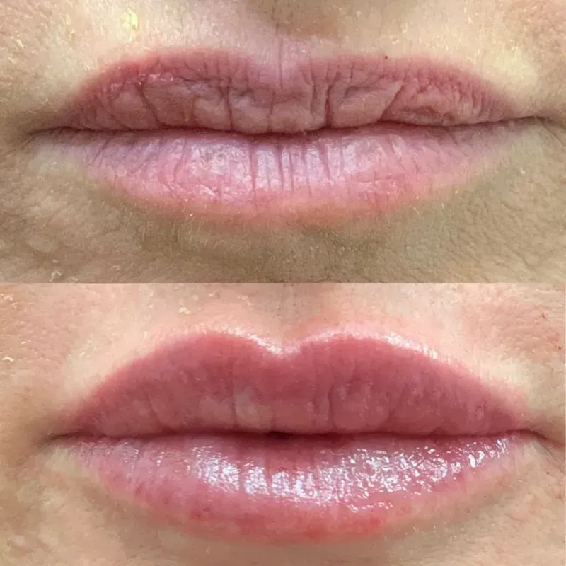 💋 Surcos Nasogenianos