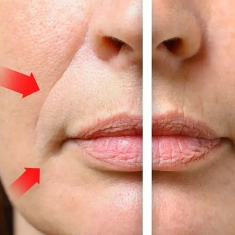 💋 Surcos Nasogenianos