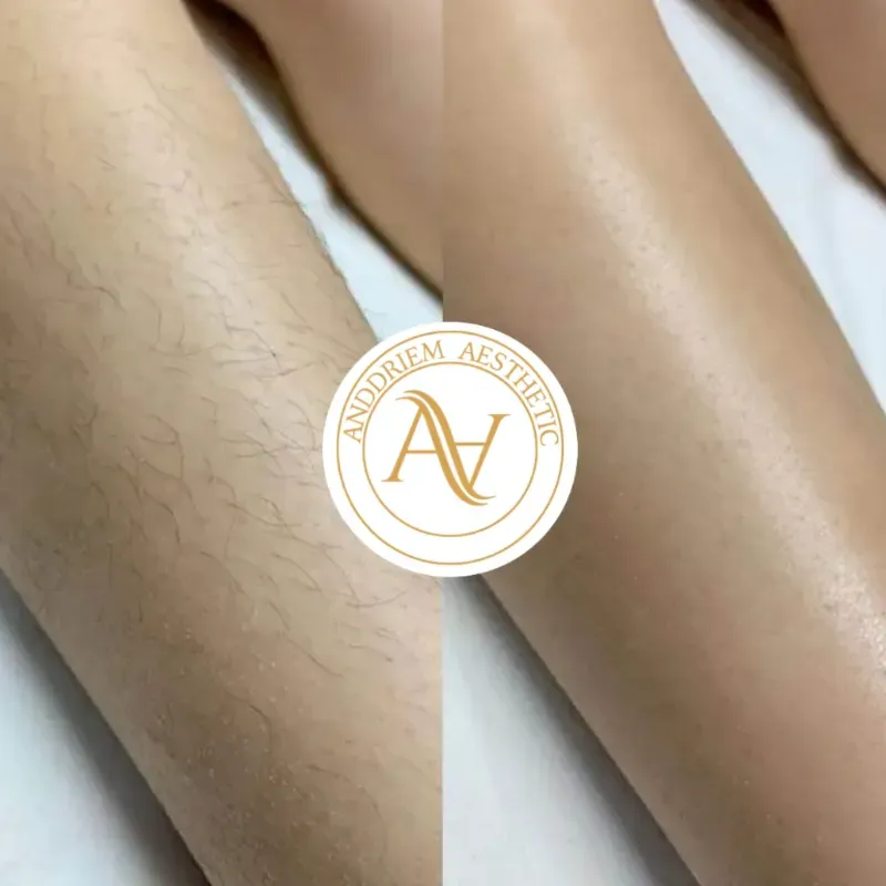 Depilación con Cera 