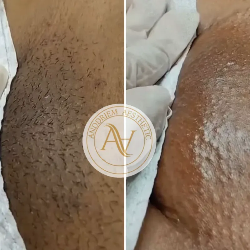 Depilación con Cera 