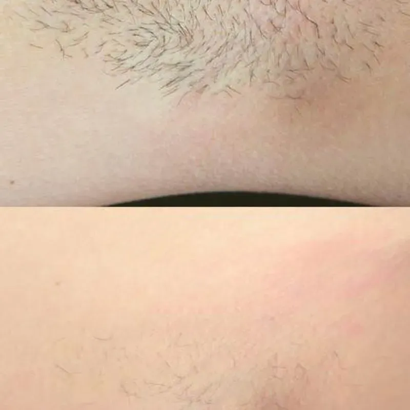 DEPILACION LASER - RETIRO DE VELLO