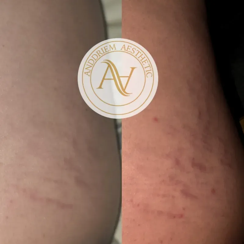 Dermapen para Estrías Corporales