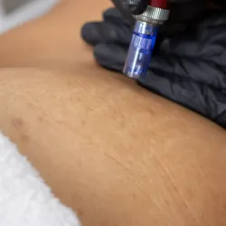 Dermapen para Estrías Corporales