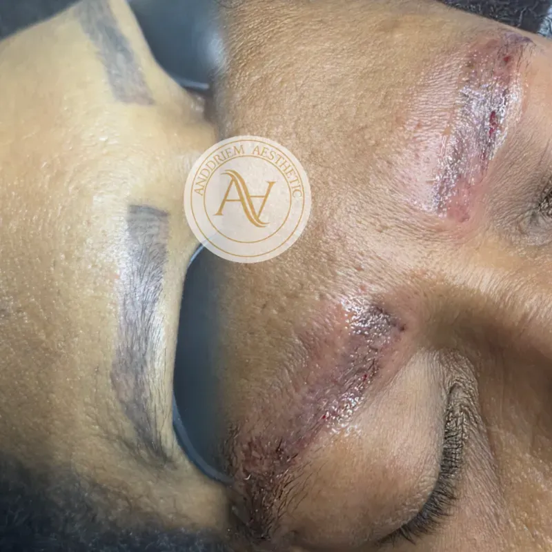 Láser Retiro de Micropigmentación 