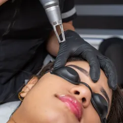 Láser Retiro de Micropigmentación 