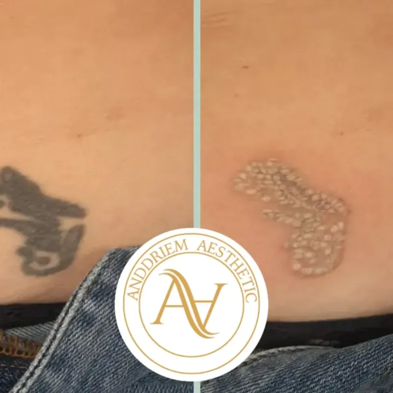 Láser Retiro de Tatuajes