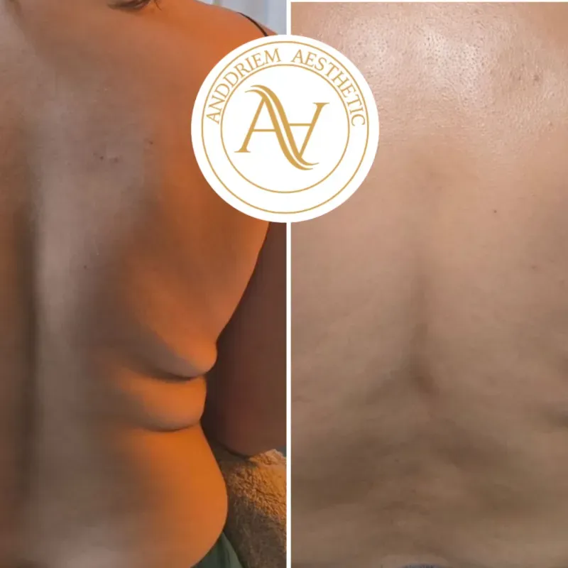 Maderoterapia Corporal