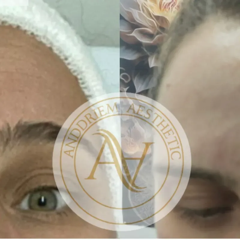 Maderoterapia Facial o en brazos 