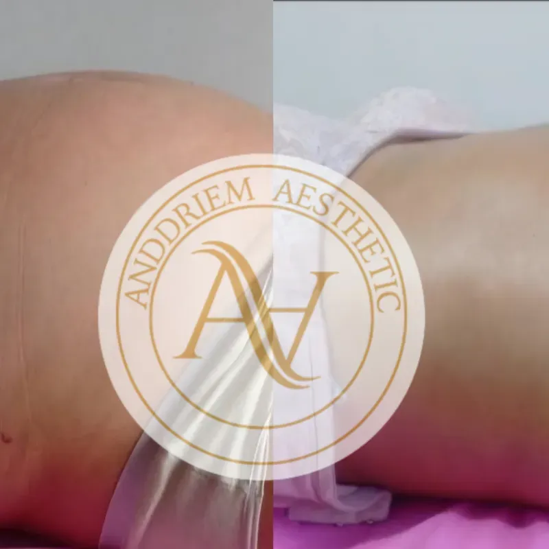 Terapia de Drenaje Linfático