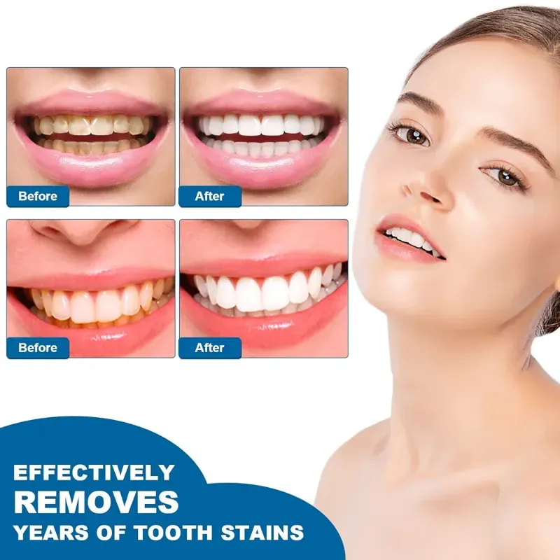 Blanqueador de Dientes