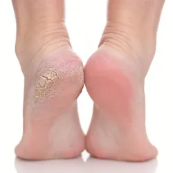 Tratamiento anti callosidad para los pies 