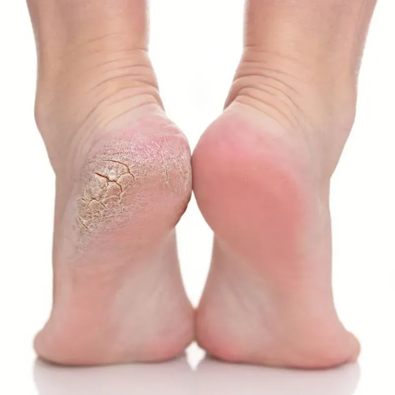 Tratamiento anti callosidad para los pies 