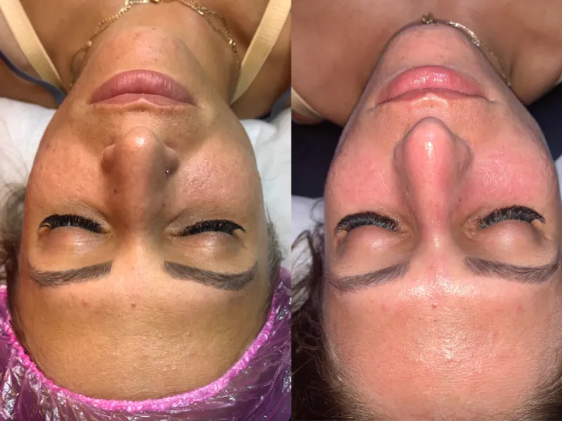 Limpieza facial profunda 