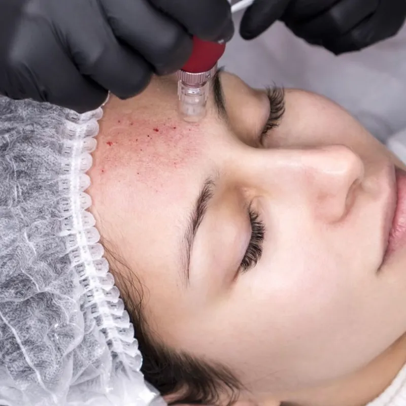 Tratamiento con Dermapen 