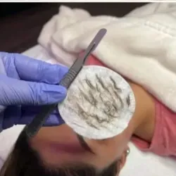 Dermaplening 