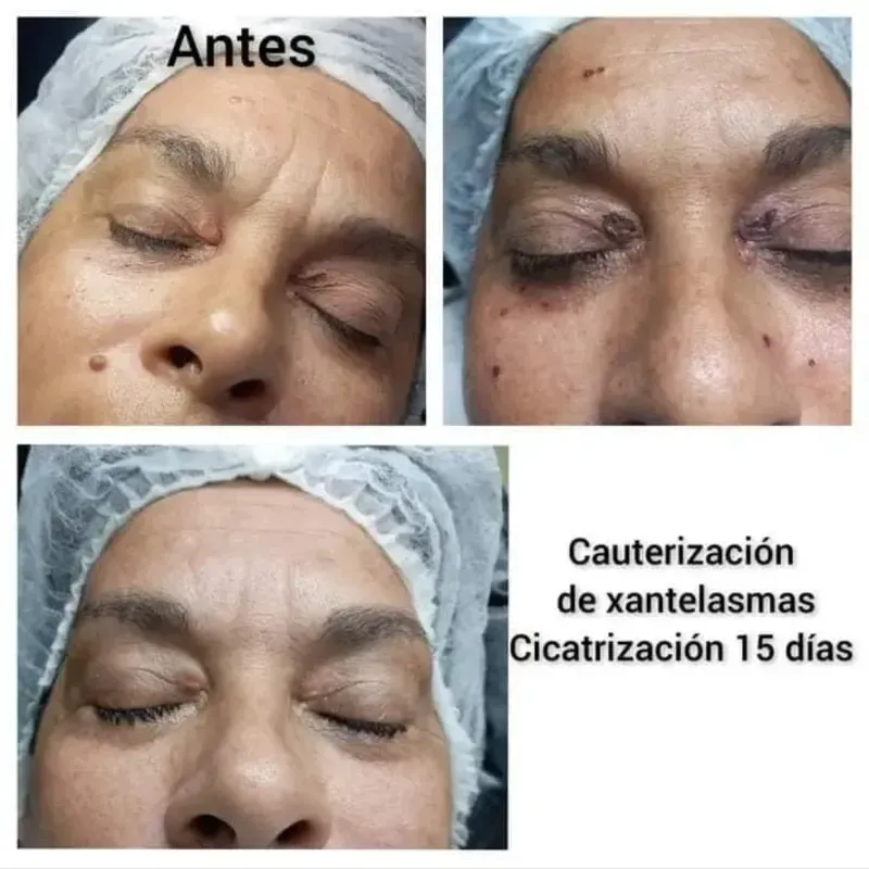 Eliminación de verrugas, xantelasmas y queratosis