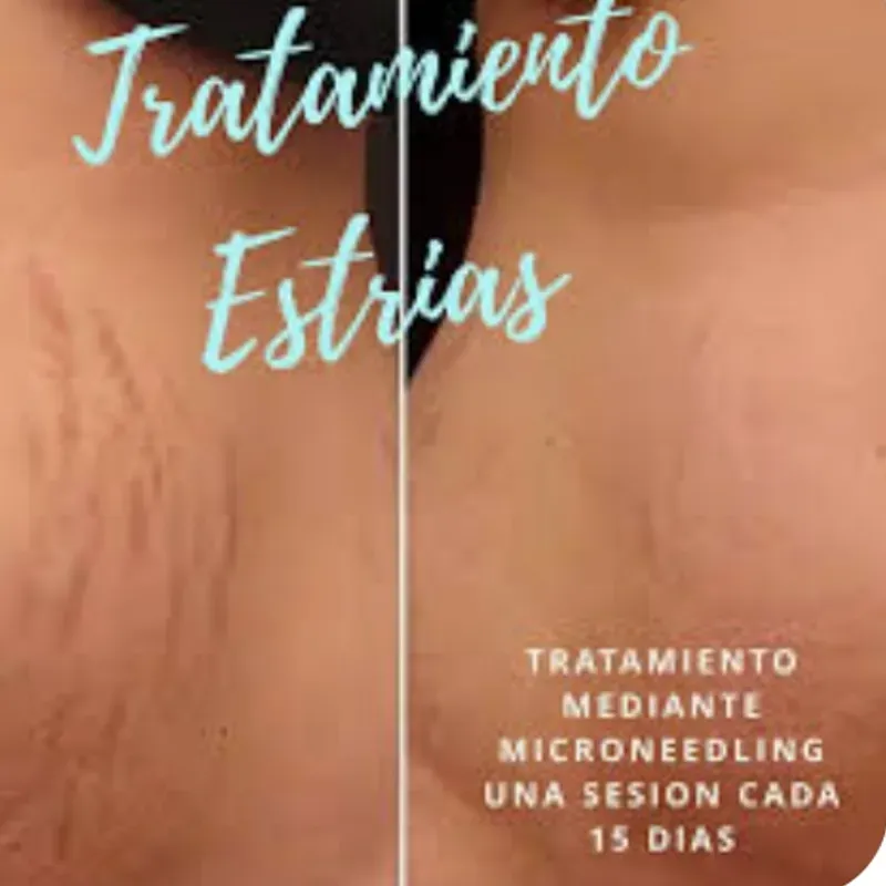 Tratamiento para las estrías 