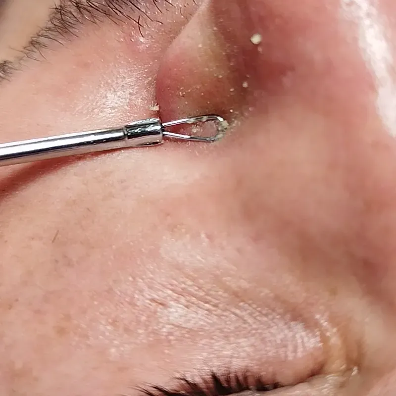 Limpieza facial 