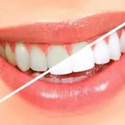 Curso BLANQUEAMIENTO DENTAL