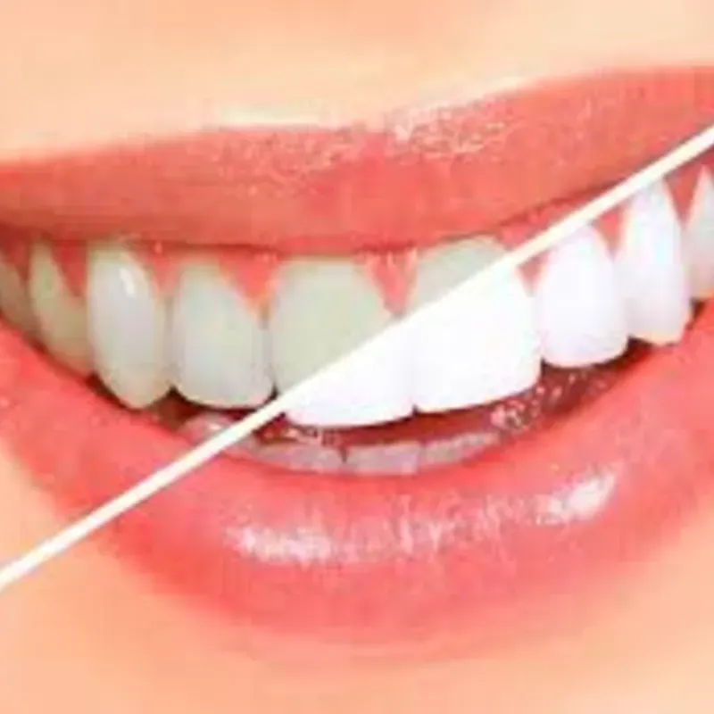 Curso BLANQUEAMIENTO DENTAL