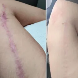 Bio-Corrección Estructural de Cicatrices (Dermapen)