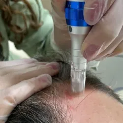 Bioestimulación Capilar Regenerativa (Dermapen)