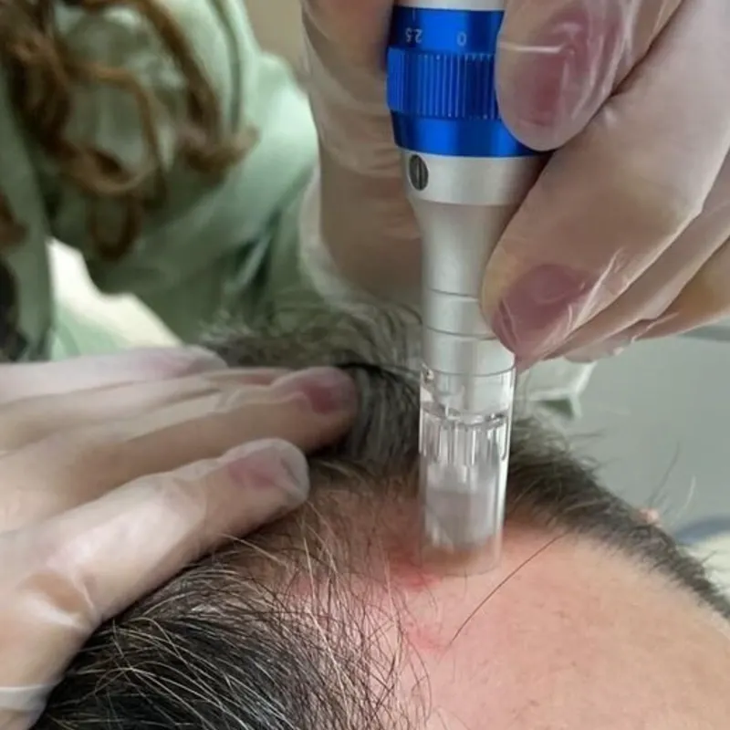 Bioestimulación Capilar Regenerativa (Dermapen)