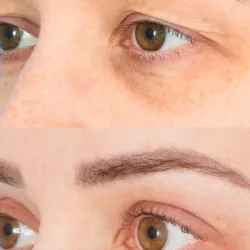 Blefaroplastia No Quirúrgica