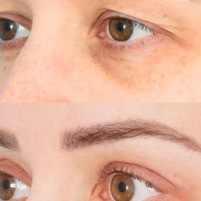 Blefaroplastia No Quirúrgica