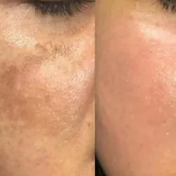 CIT Aclarante & Radiance Glow