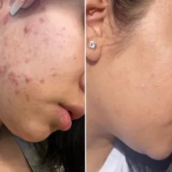 CIT Acne Prevention