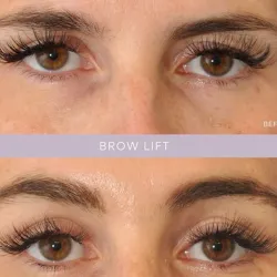 Lifting de Cejas (Brow Lift Fox-Eye)