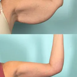 Lifting de Rodillas o Codos (Plasmapen)