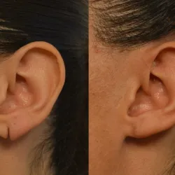 Rejuvenecimiento de Lóbulos de Oreja