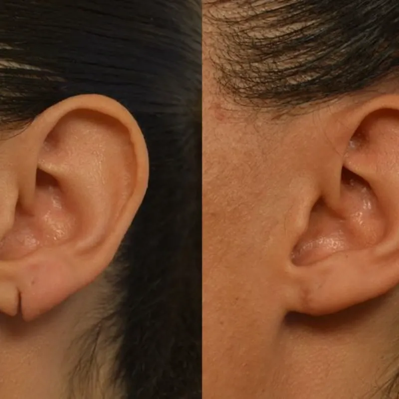 Rejuvenecimiento de Lóbulos de Oreja