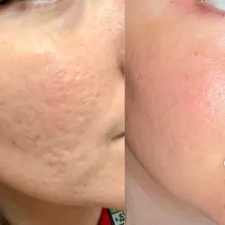 Terapia de Cicatrices de Acné Avanzada