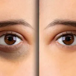 Vision Glow (Aclaramiento de Ojeras)
