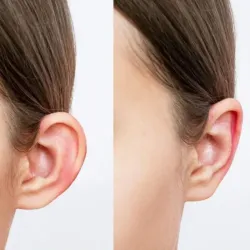 Zona Preauricular (Arrugas de Sonrisa)