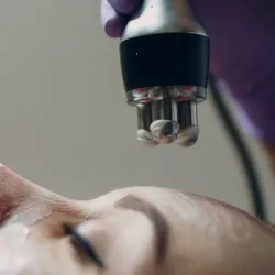 Radiofrecuencia facial 