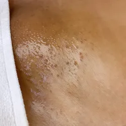 Depilacion brasileña 