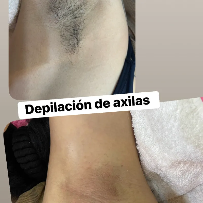 Depilacion de axilas