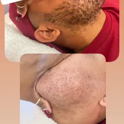 Depilación De barba 