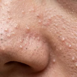 Acné Comedónico (Grado 1 - Leve)