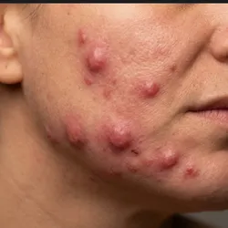 Acné Nodular (Grado 3 - Severo)