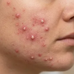Acné Papulopustuloso (Grado 2 - Moderado)