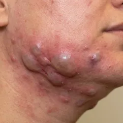 Acné Quístico (Grado 4 - Muy Severo)