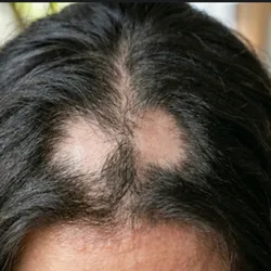 Alopecia por Estrés y Deficiencia