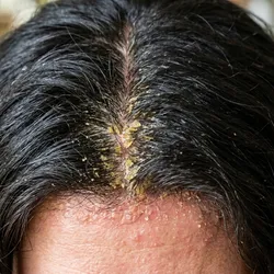 Caspa y Dermatitis Seborreica
